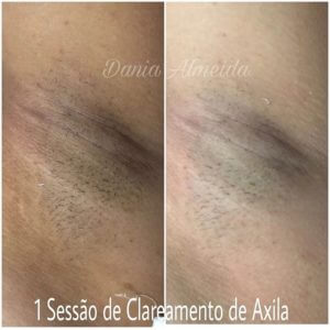 Novo Clareamento orgânico Corporal