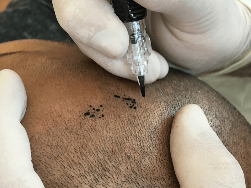 Micropigmentação capilar preço